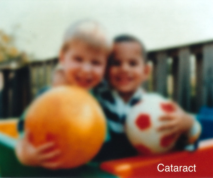 Picture simulating cataracts